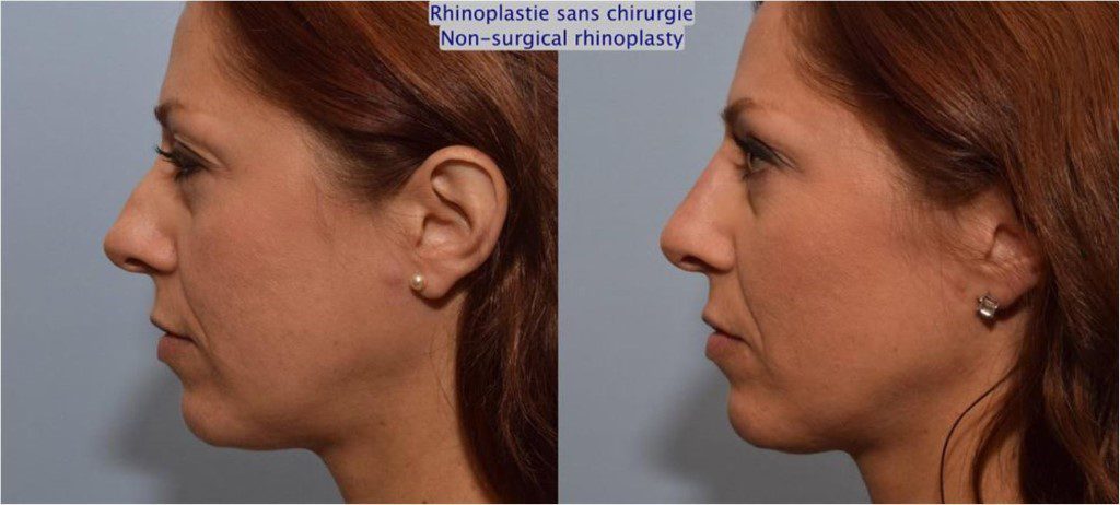 Profil latéral d'une femme avant et après une rhinoplastie non chirurgicale à Montréal