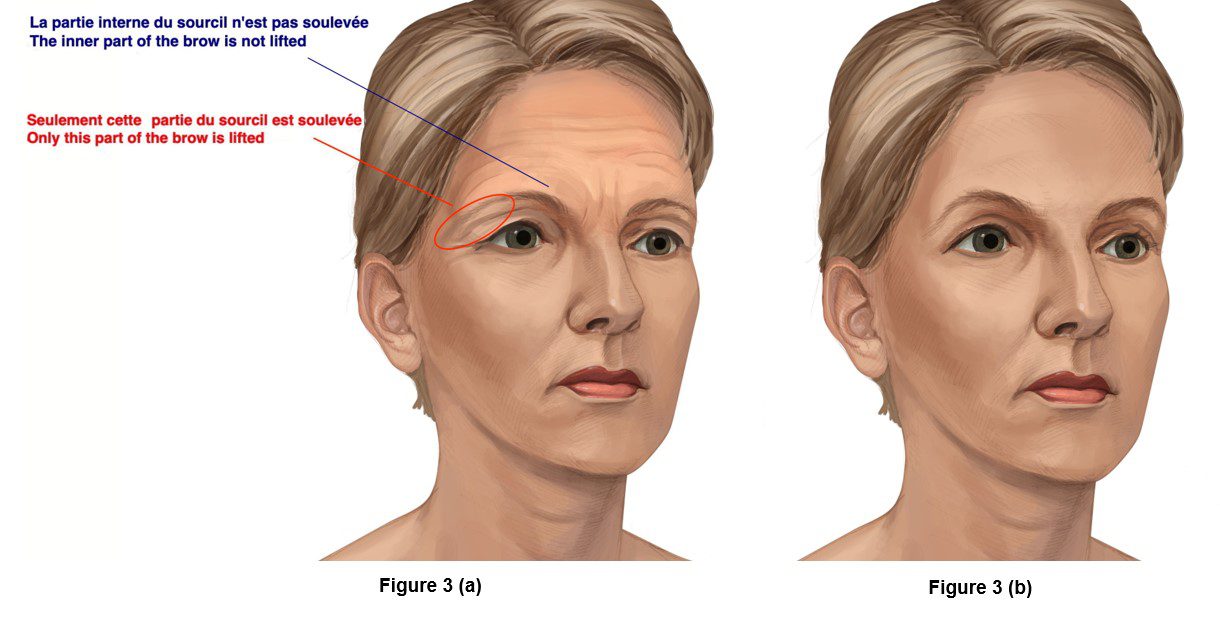 Figure 3 (a) aging changes of the brow and forehead and (b) after brow lift. Note that only the part of the brow near the temple is lifted. The inner part, near the nose is left untouched to avoid a surprised look