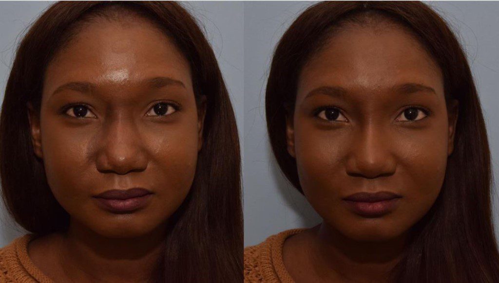 A woman before and after nonsurgical Rhinoplasty in Montreal