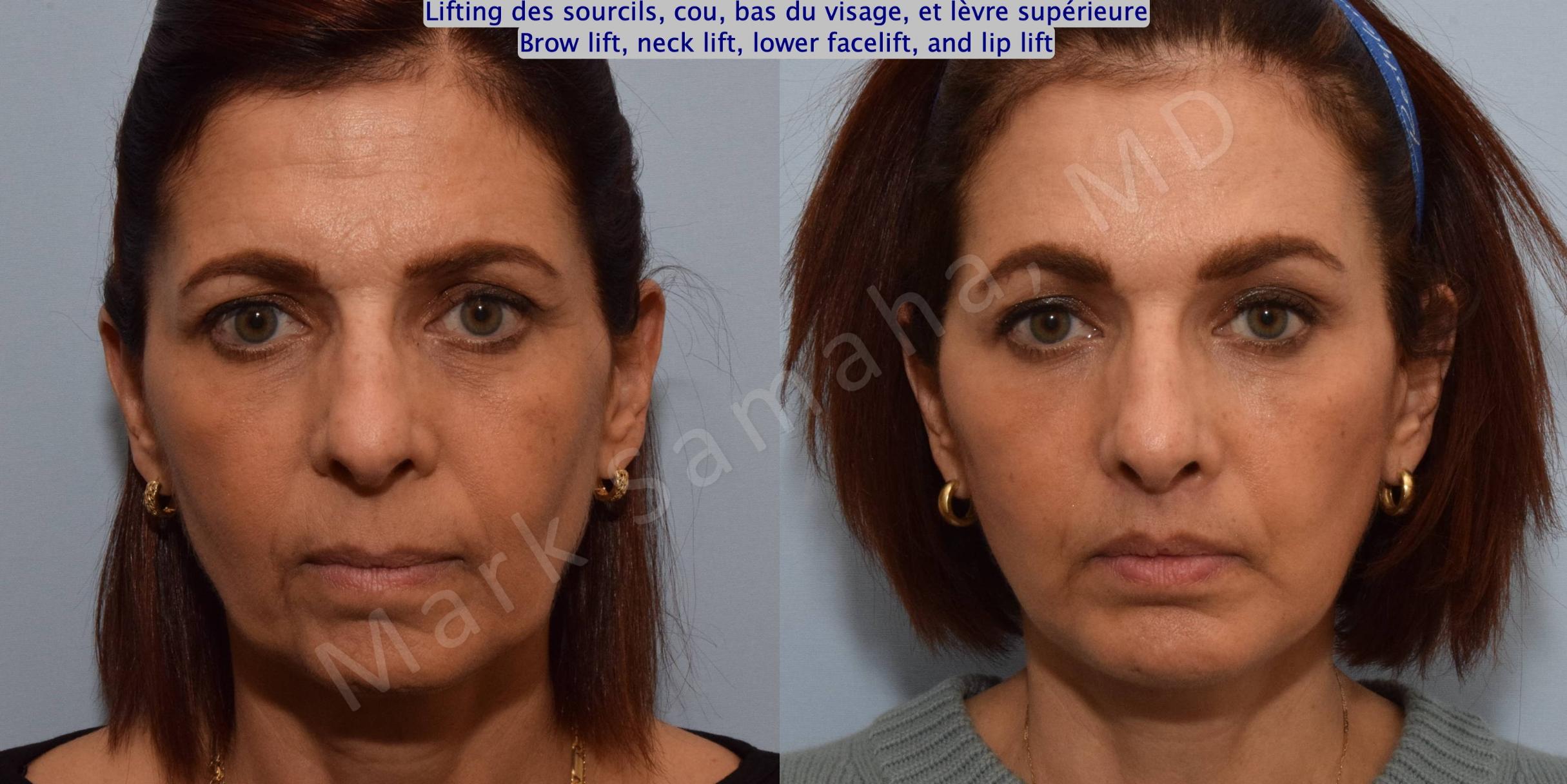 Case 195 – Brow lift, neck lift, lower facelift, and lip lift