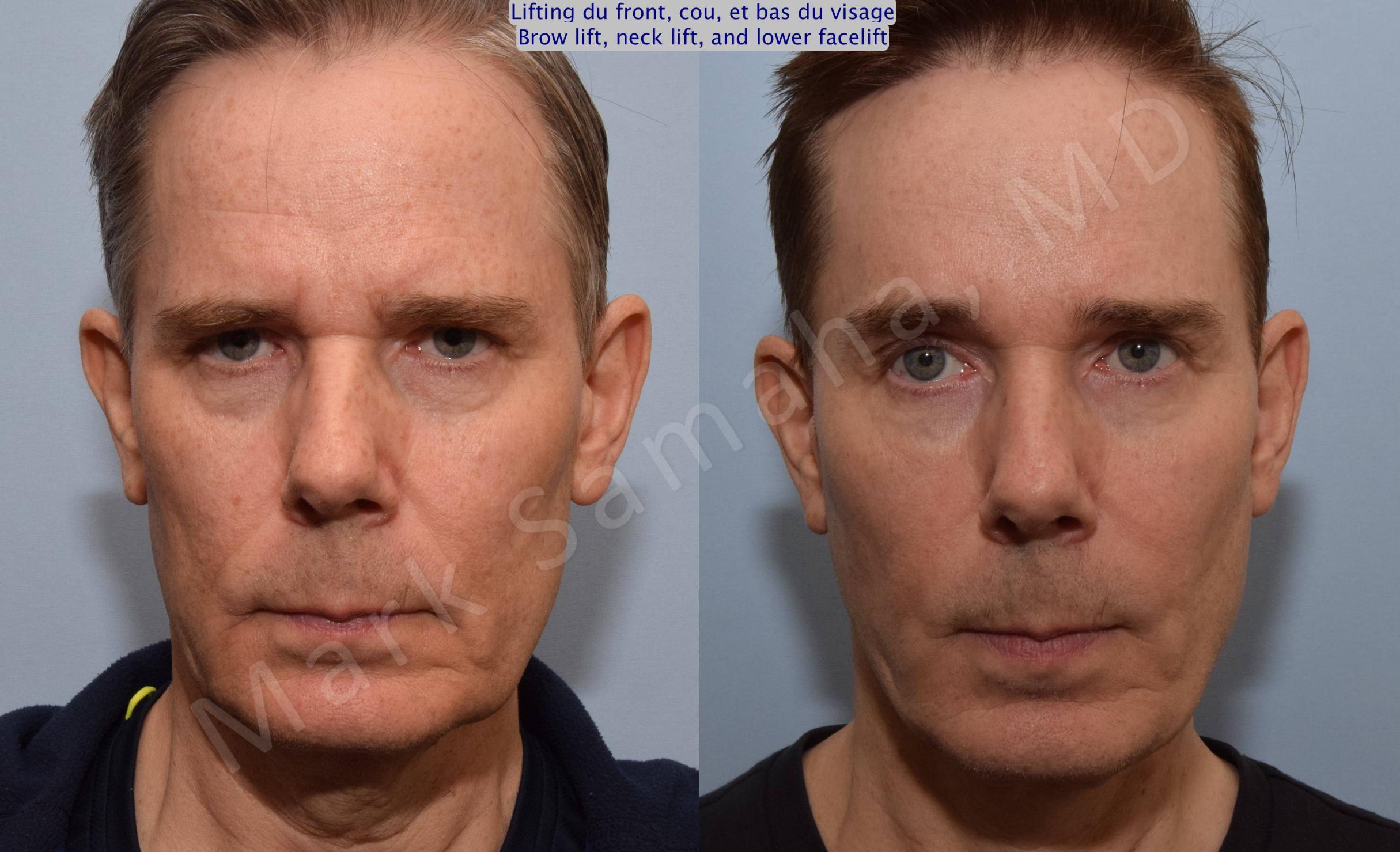 Case 91 – Brow lift, neck lift, and lower facelift