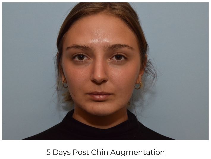 Maximum Results/ Minimum Recovery - chin after 5 days