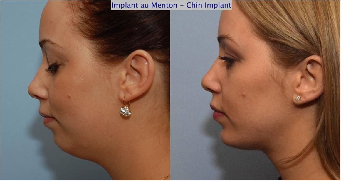 Chin Implant Before-After Montreal