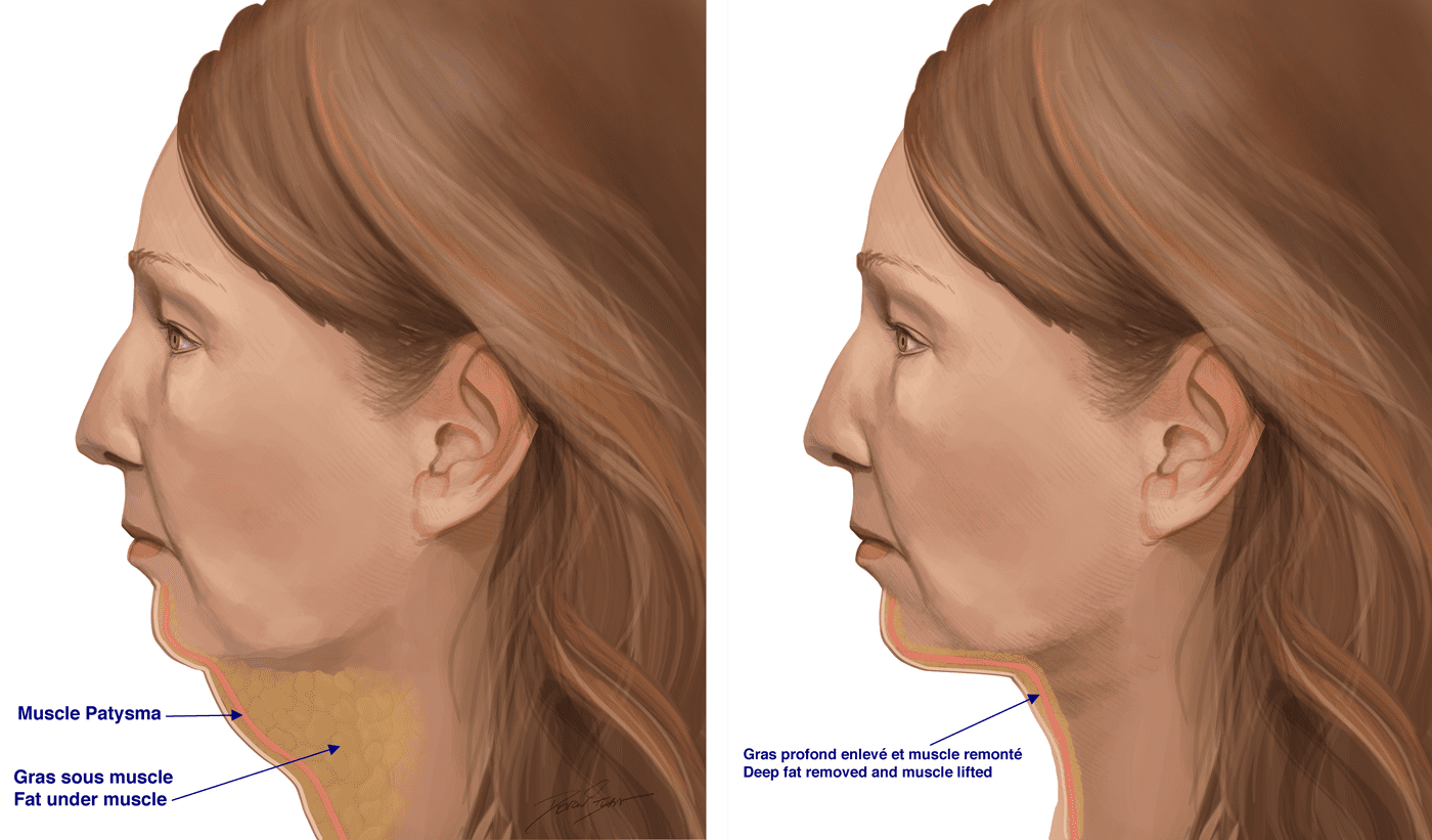 Before and After Deep Neck Lift illustration