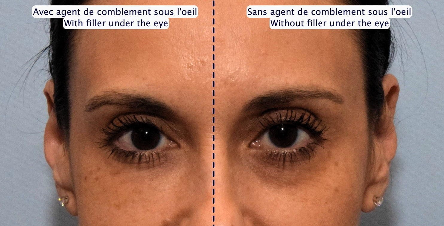 Dermal Fillers Under Eyes - with and without filler Montreal