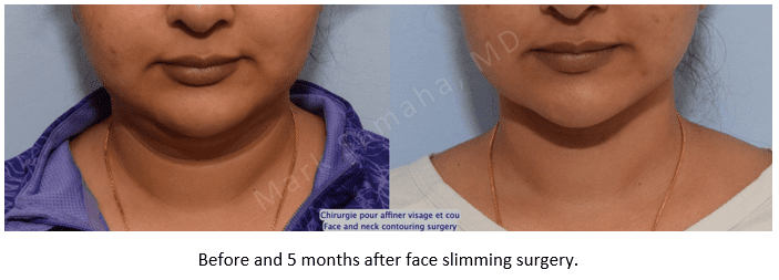 Before and 5 months after face slimming surgery