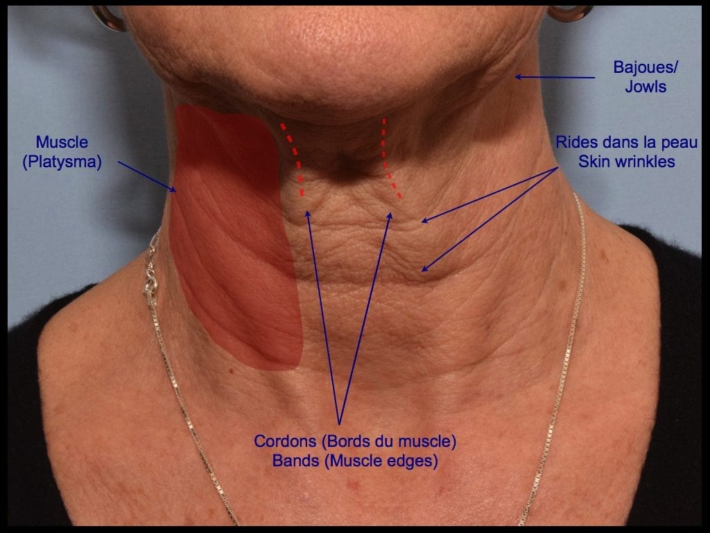 overlay of information describing parts of the neck