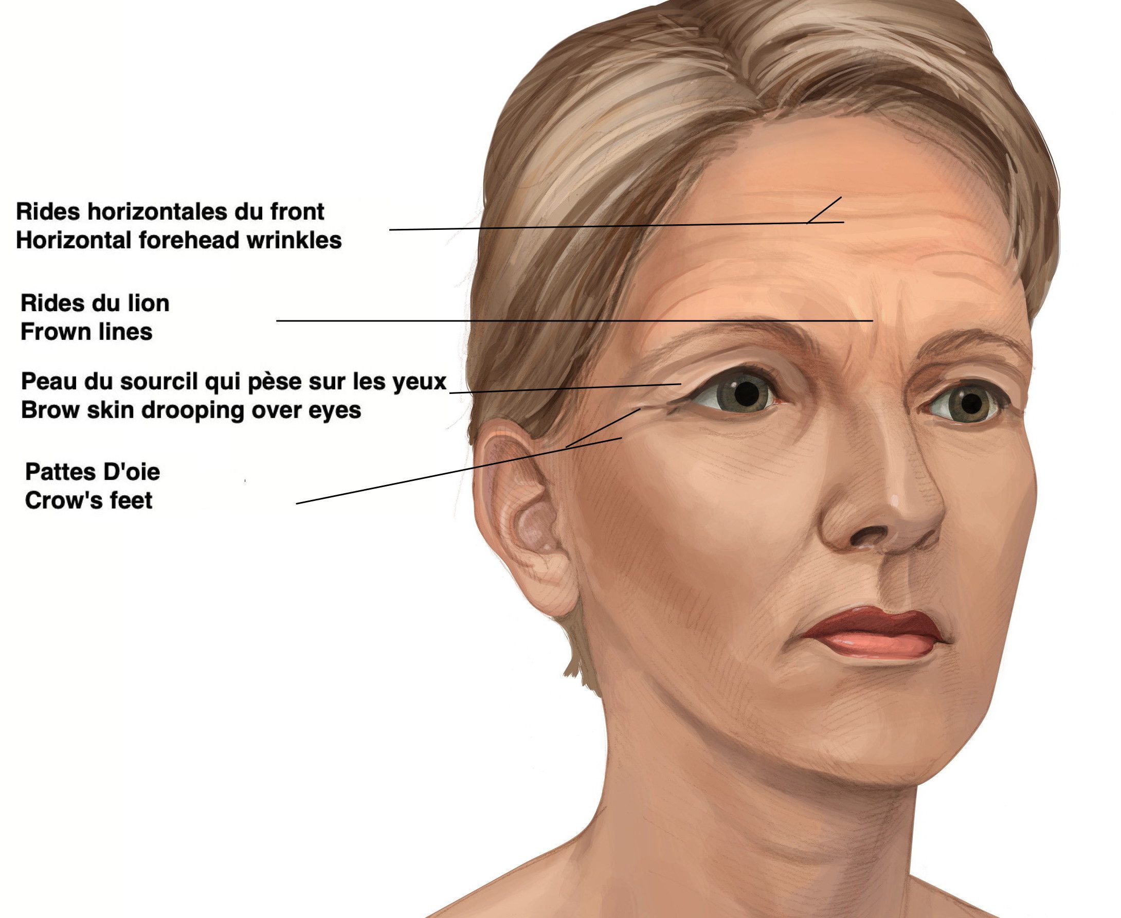 Image 2 (a) : Femme plus âgée avec des changements dus au vieillissement du sourcil. Le sourcil a perdu son arche. Il est plus horizontal, positionné plus bas sur l’os de la cavité orbitaire. L’excès de peau pend par-dessus l’œil et il y a des rides sur le front.