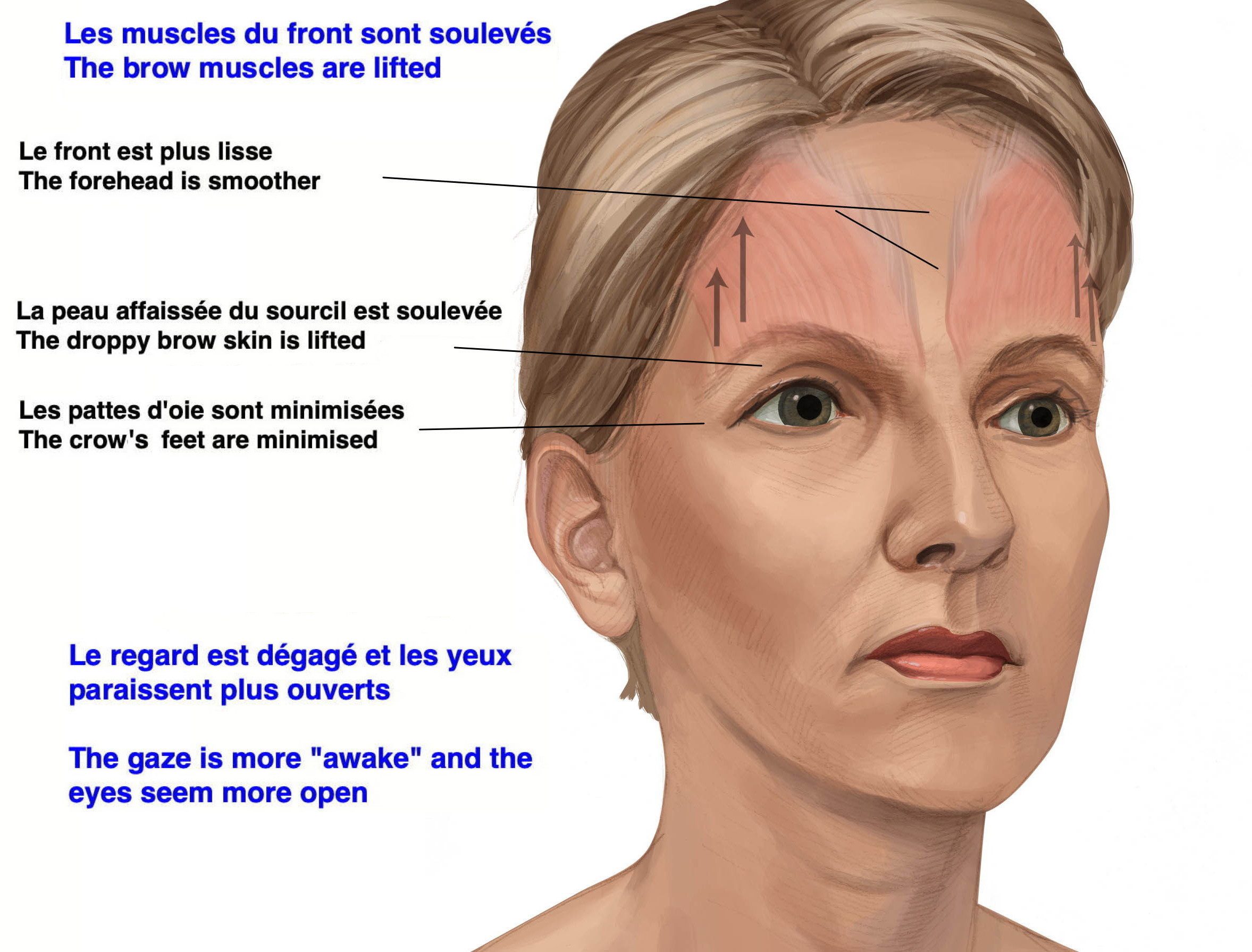 Figure 2 (b): Brow lift procedure shown where the muscle of the forehead is lifted to reposition the brows, recover the arch, eliminate the excess skin and improve he wrinkles in the forehead.