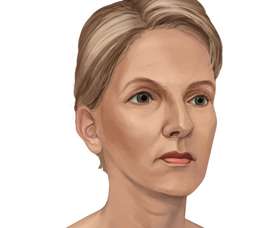 Figure 2 (c): After brow lift surgery.