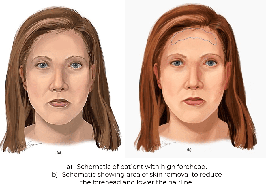 a) Schematic of patient with high forehead. b) Schematic showing area of skin removal to reduce the forehead and lower the hairline.