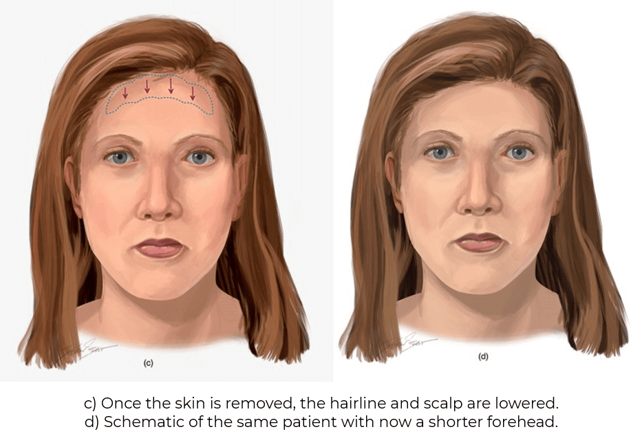 c) Once the skin is removed, the hairline and scalp are lowered. d) Schematic of the same patient with now a shorter forehead.