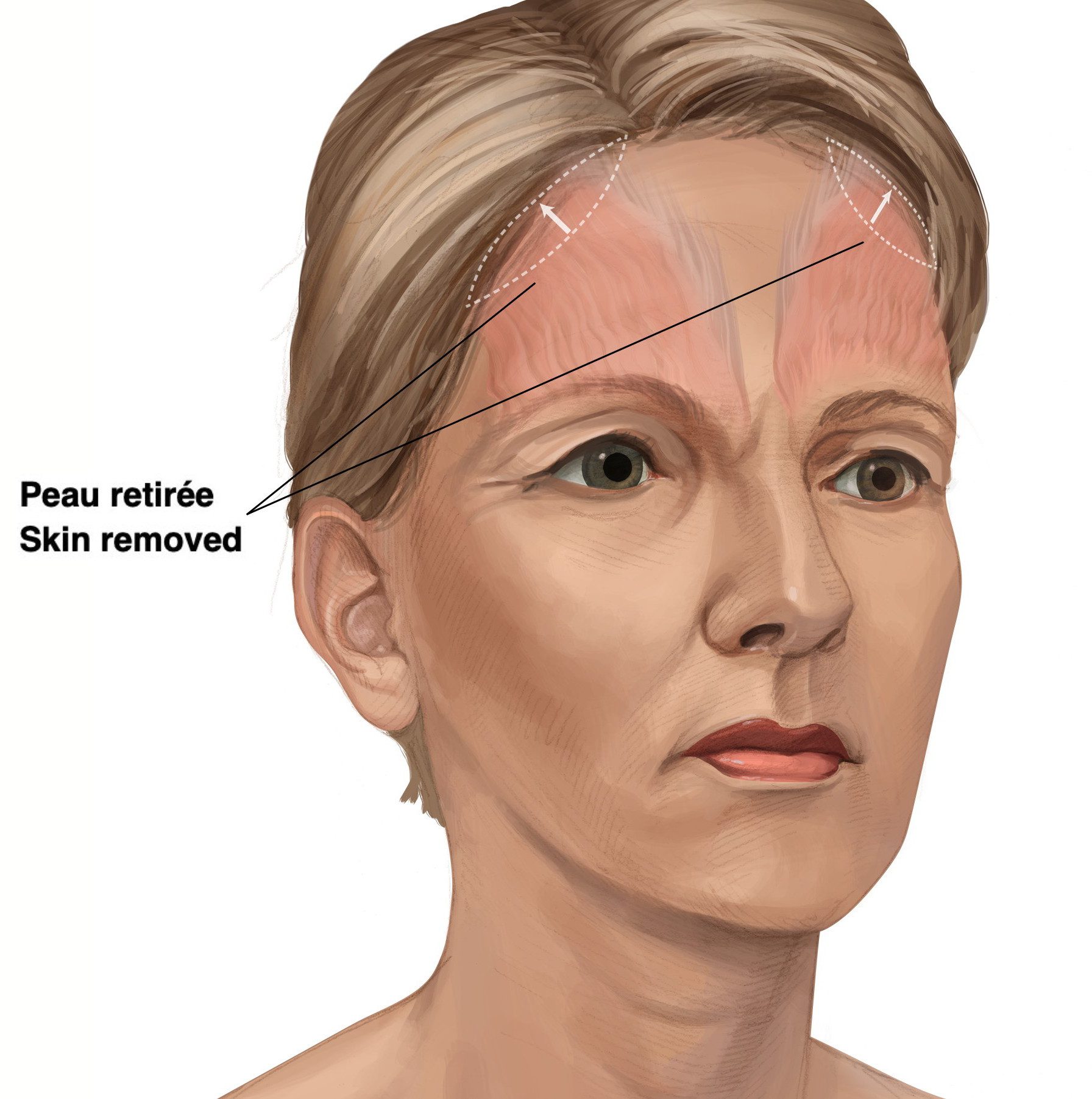 Figure 4: Ellipse of skin removed in open brow lift procedure. The width of these ellipses are carefully aligned with the portion of the brow to be lifted. The width of each side is usually different and is measured separately to correct asymmetries by removing more skin on the side where the brow is lower.