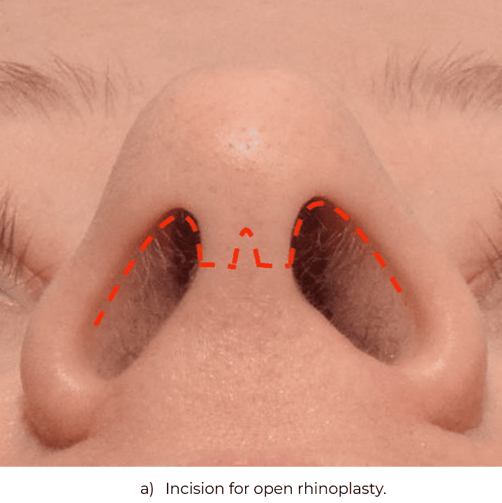 a) Incision for open rhinoplasty.