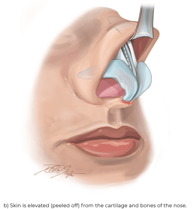 b) Skin is elevated (peeled off) from the cartilage and bones of the nose.