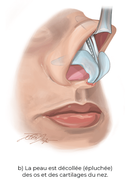 b) La peau est décollée (épluchée) des os et des cartilages du nez.