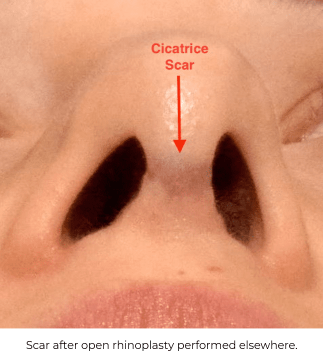 Scar after open rhinoplasty performed elsewhere.