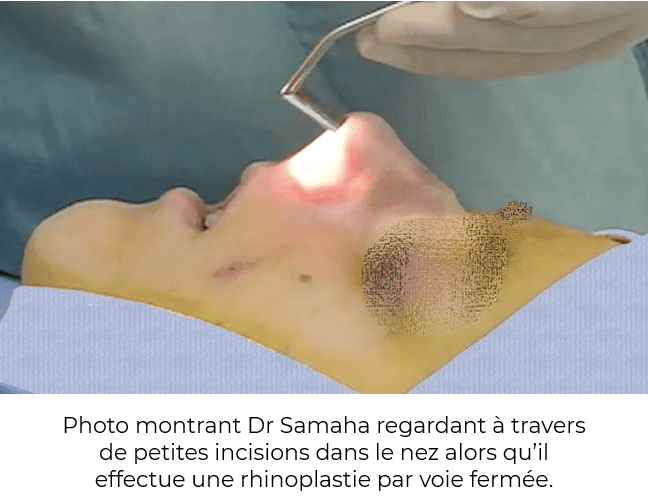 Photo montrant Dr Samaha regardant à travers de petites incisions dans le nez alors qu’il effectue une rhinoplastie par voie fermée.