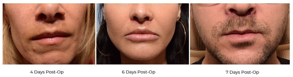 Patient results a few days after lip lift procedure with the Maximum Result Minimum Recovery™ approach in Montreal.
