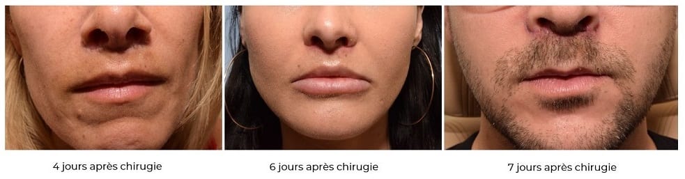 Résultats du patient quelques jours après la procédure de lifting des lèvres avec l'approche Maximum Result Minimum Recovery™ à Montréal.
