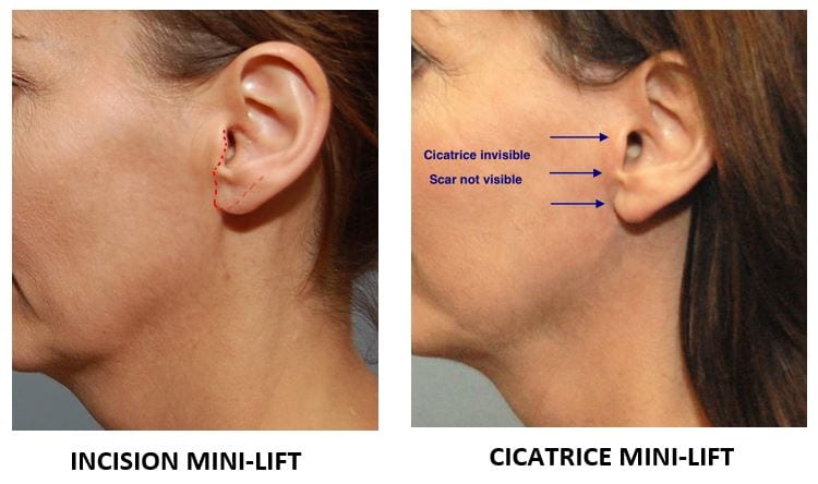 Mini placement d'incision de lifting et cicatrice près de l'oreille