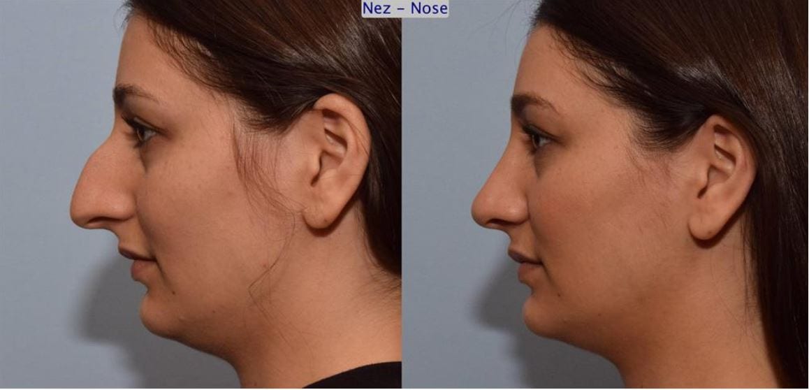 Rhinoplasty - Dorsal Hump Before-After Montreal