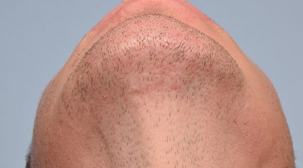 Patient with scar under chin
