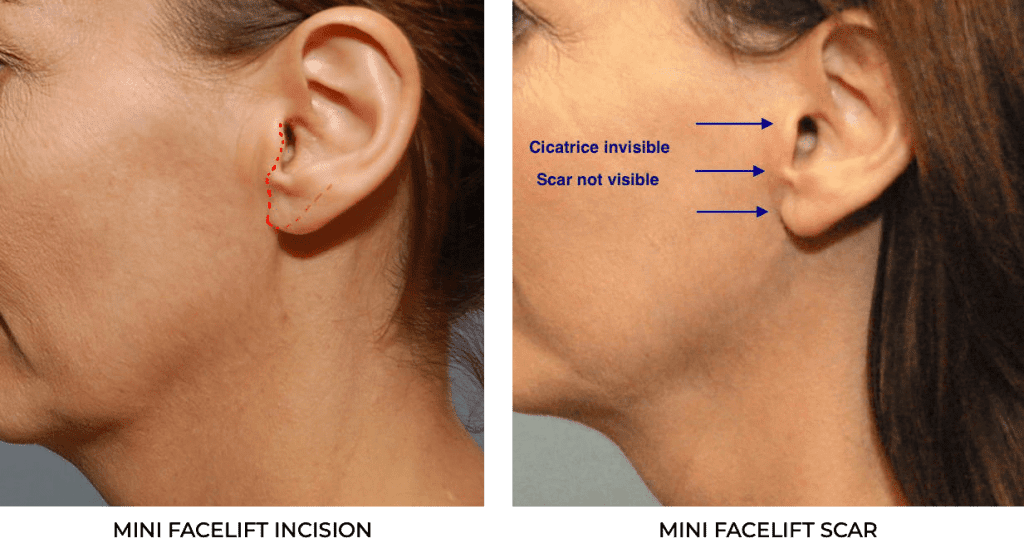 Mini facelift incision placement and scar near ear