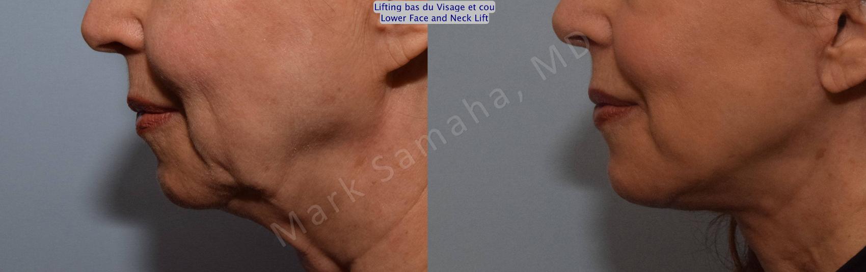 Before & After Lifting du visage / Cou - Facelift / Necklift Case 101 View #3 View in Montreal, QC