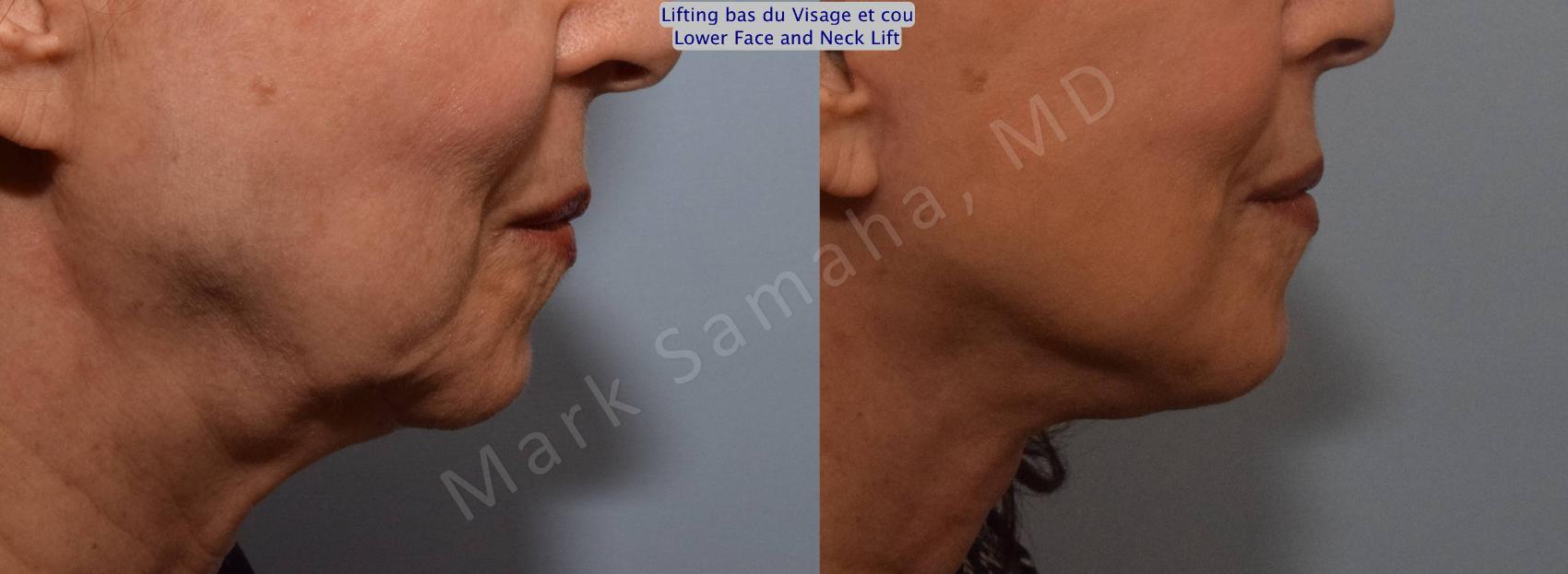 Before & After Lifting du visage / Cou - Facelift / Necklift Case 101 View #4 View in Montreal, QC