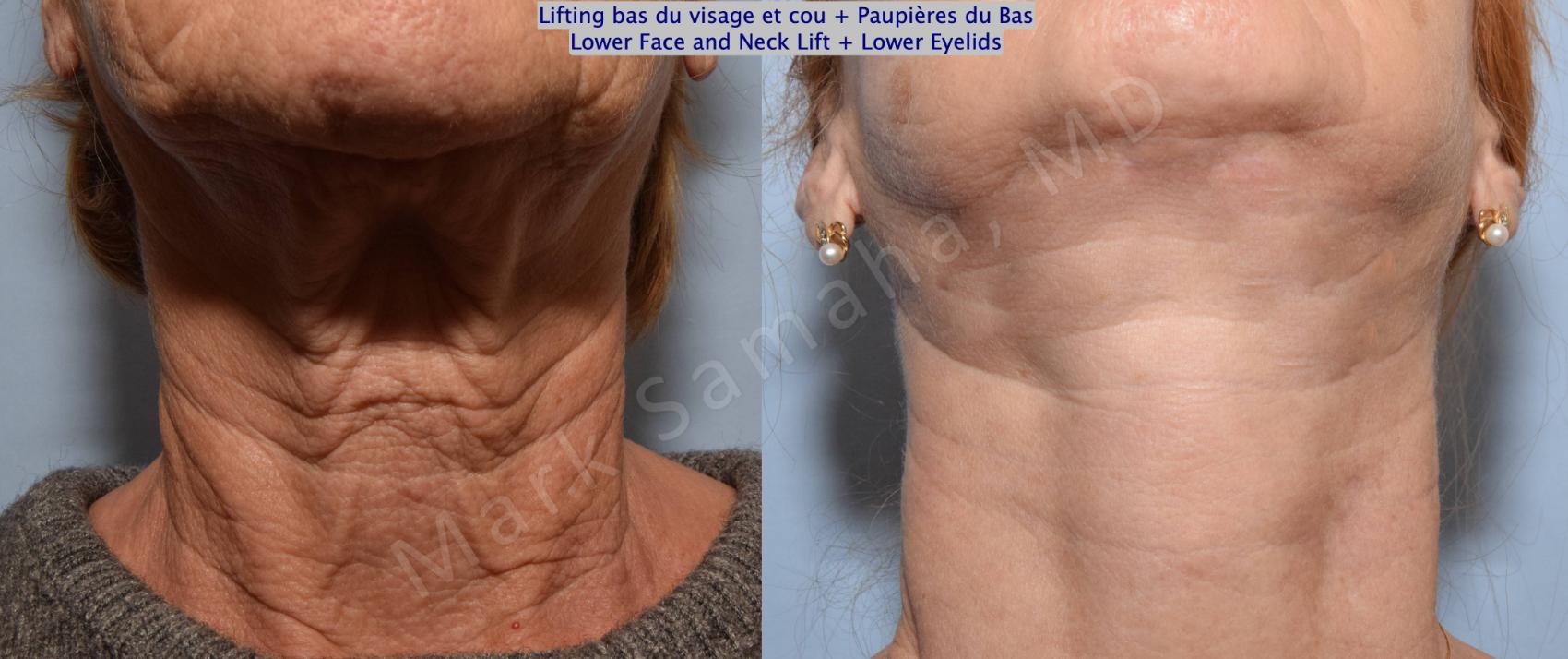 Before & After Lifting du visage / Cou - Facelift / Necklift Case 128 View #2 View in Montreal, QC