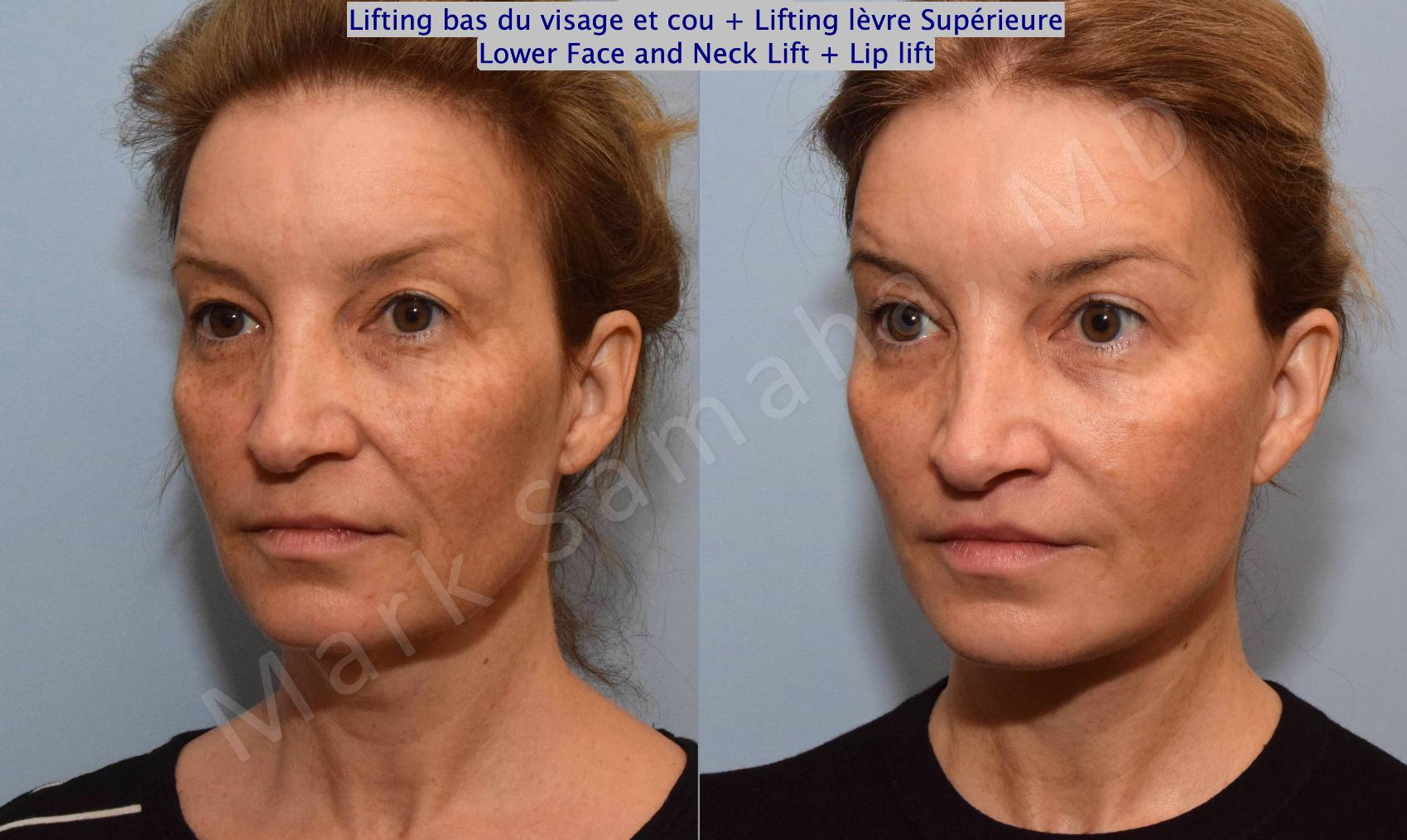 Before & After Lifting du visage / Cou - Facelift / Necklift Case 130 View #5 View in Montreal, QC