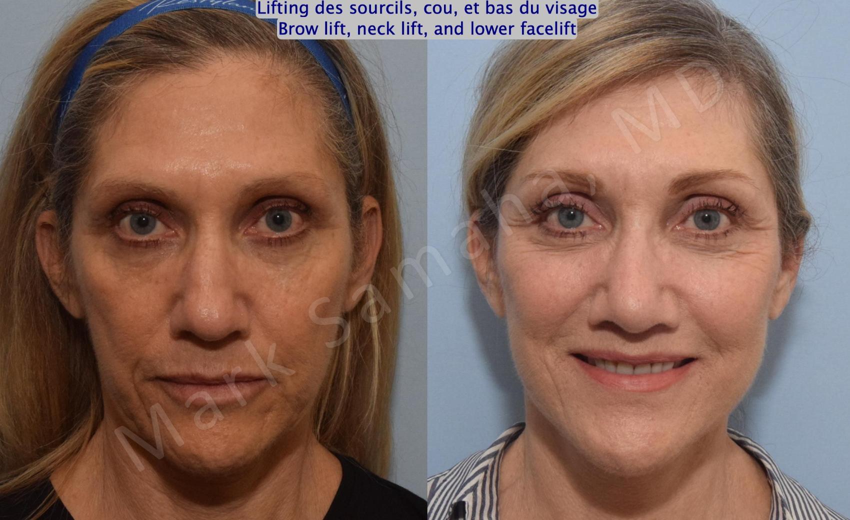 Before & After Lifting du visage / Cou - Facelift / Necklift Case 145 Front View in Montreal, QC