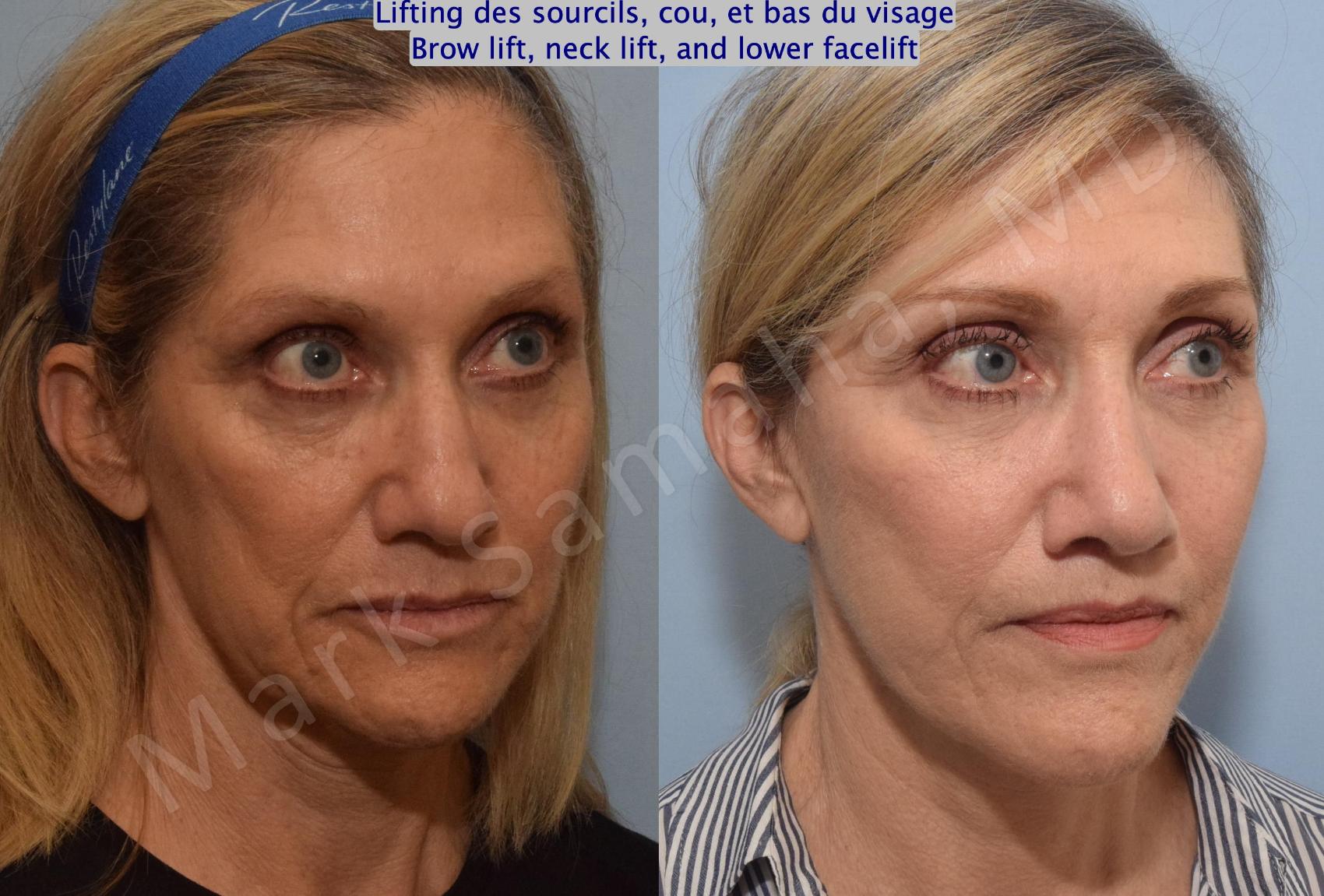 Before & After Lifting du visage / Cou - Facelift / Necklift Case 145 Right Oblique View in Montreal, QC