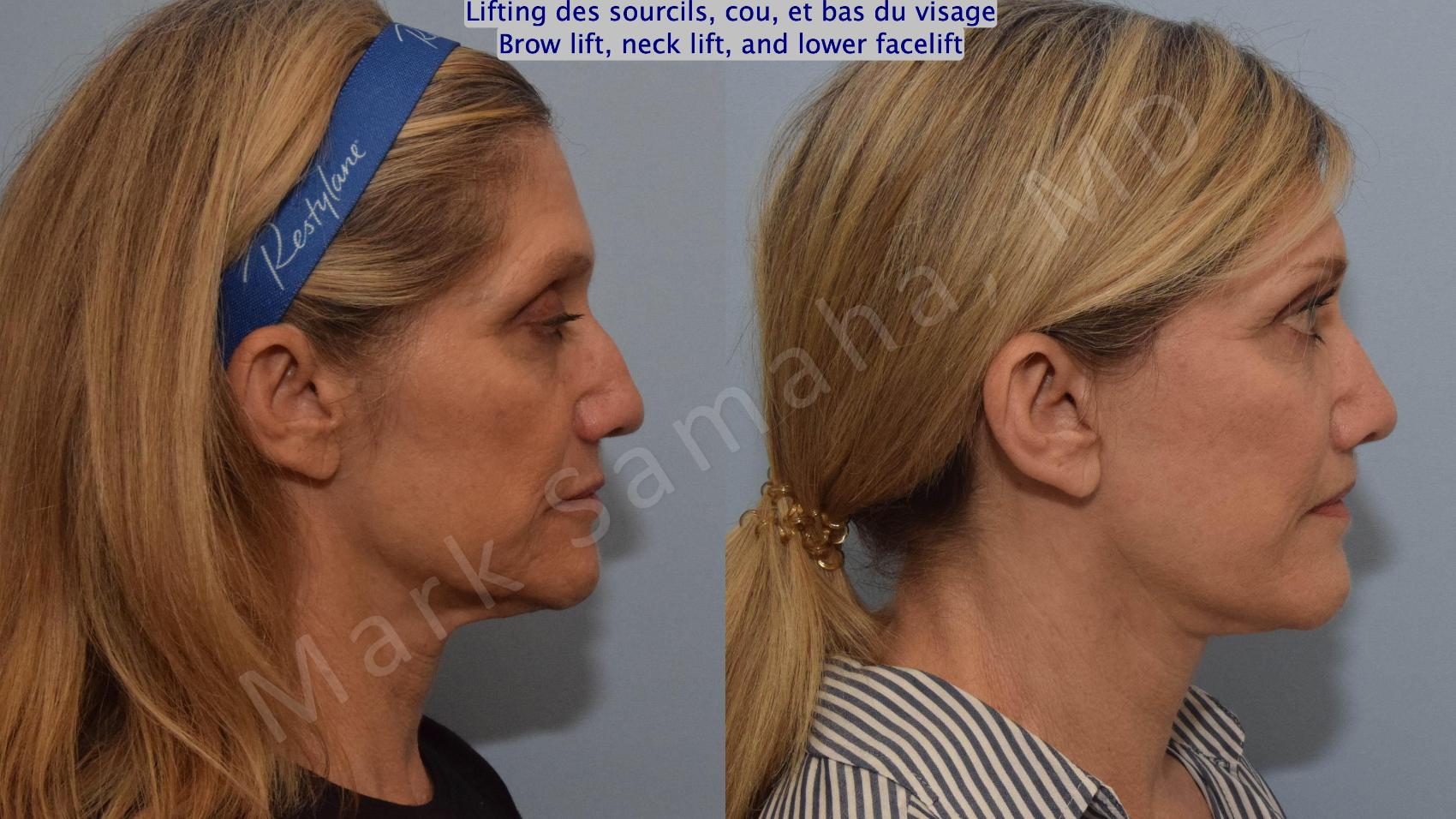 Before & After Lifting du visage / Cou - Facelift / Necklift Case 145 Right Side View in Montreal, QC