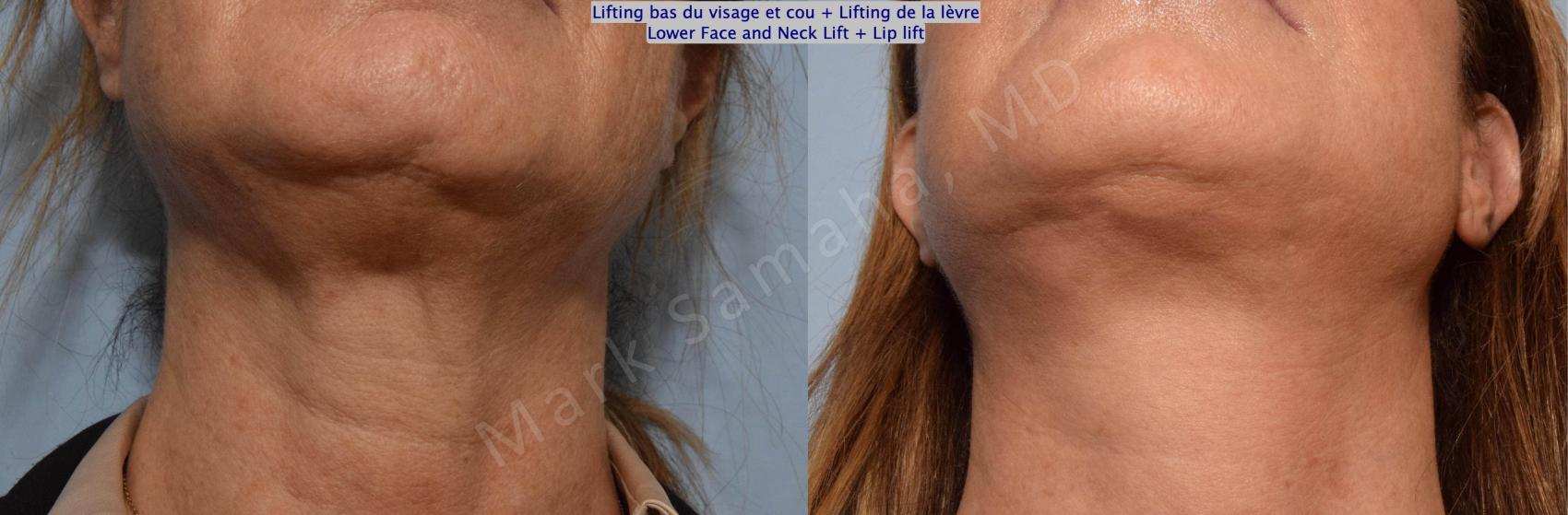 Before & After Lifting du visage / Cou - Facelift / Necklift Case 151 Basal View in Montreal, QC