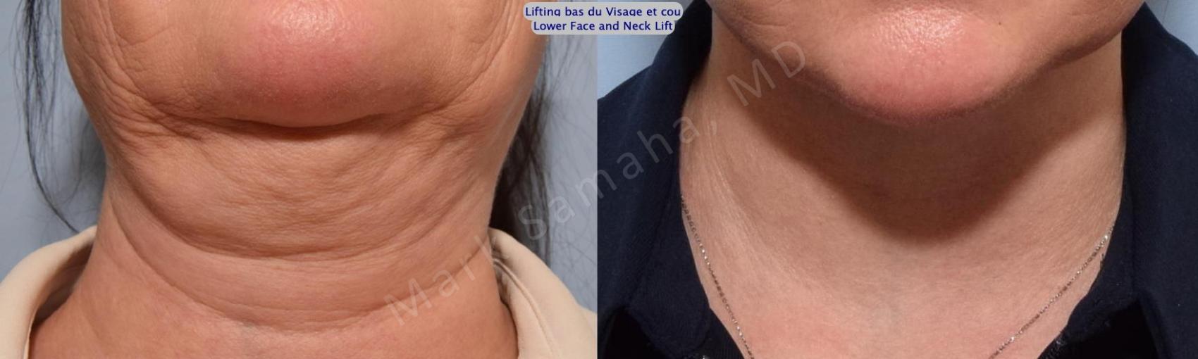 Before & After Lifting du visage / Cou - Facelift / Necklift Case 153 Basal View in Montreal, QC