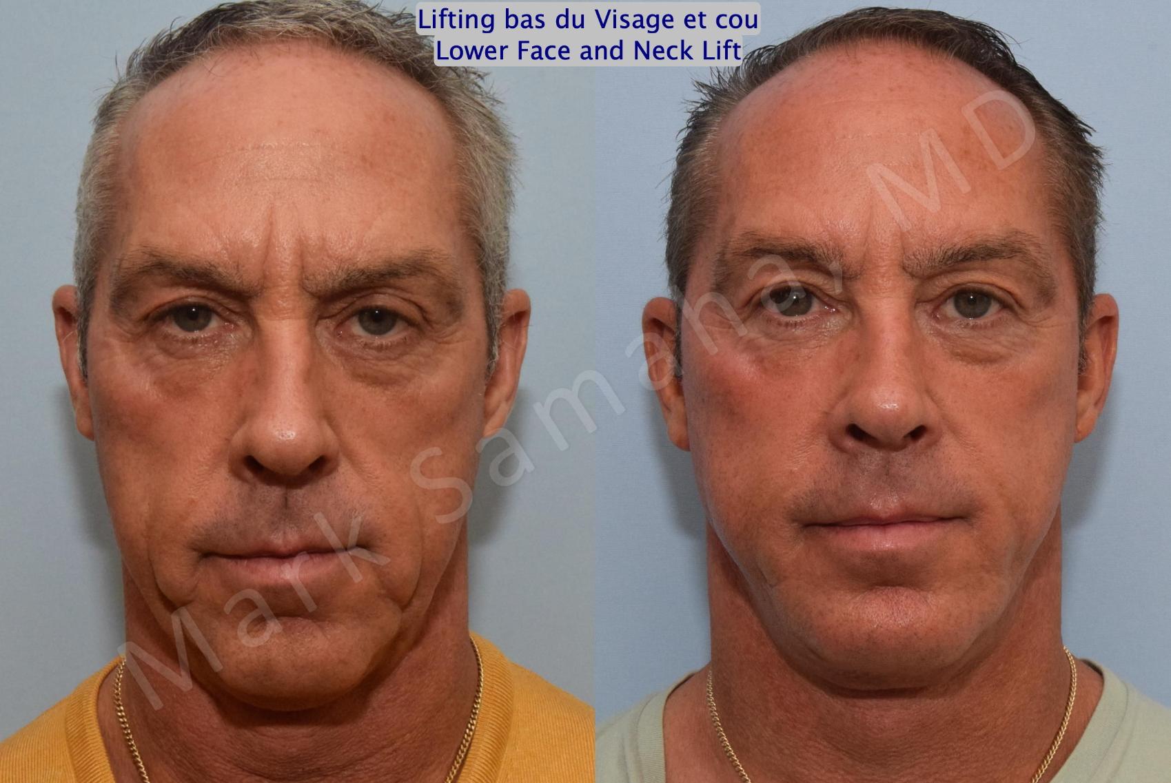 Before & After Lifting du visage / Cou - Facelift / Necklift Case 154 Front View in Montreal, QC
