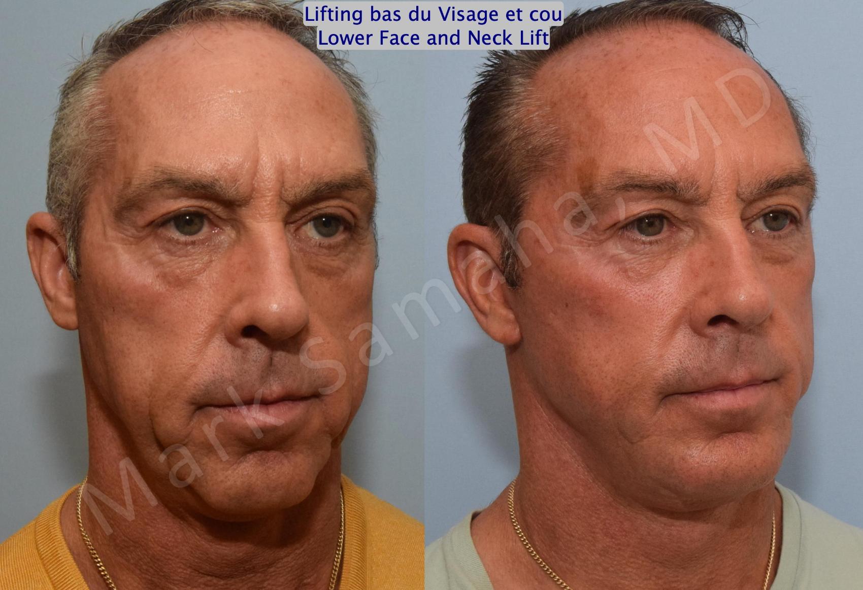 Before & After Lifting du visage / Cou - Facelift / Necklift Case 154 Right Oblique View in Montreal, QC