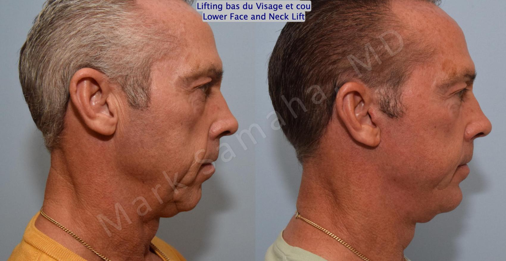 Before & After Lifting du visage / Cou - Facelift / Necklift Case 154 Right Side View in Montreal, QC