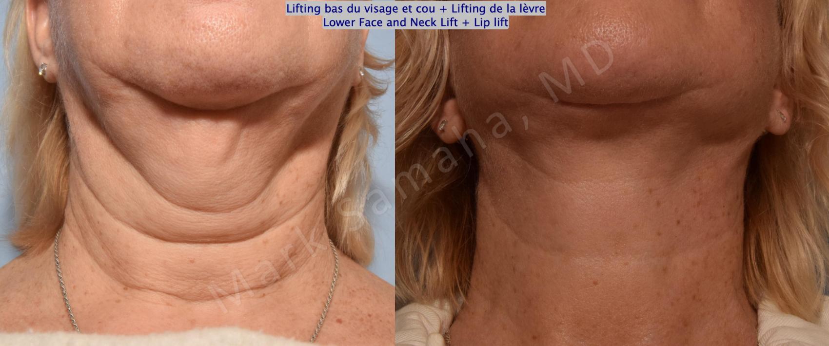 Before & After Lifting du visage / Cou - Facelift / Necklift Case 158 Neck Cou View in Montreal, QC