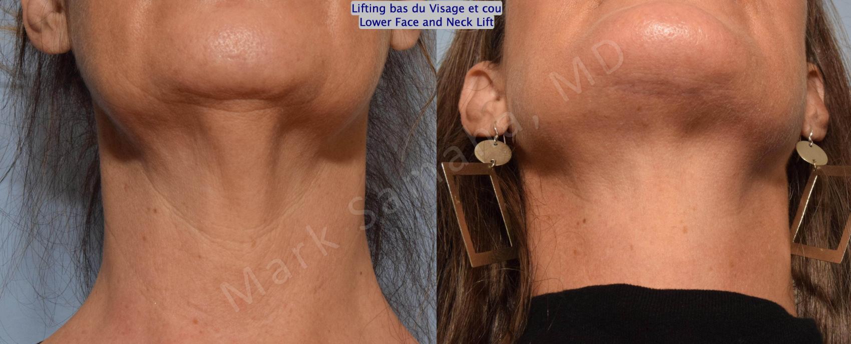 Before & After Lifting du visage / Cou - Facelift / Necklift Case 159 Neck Cou View in Montreal, QC