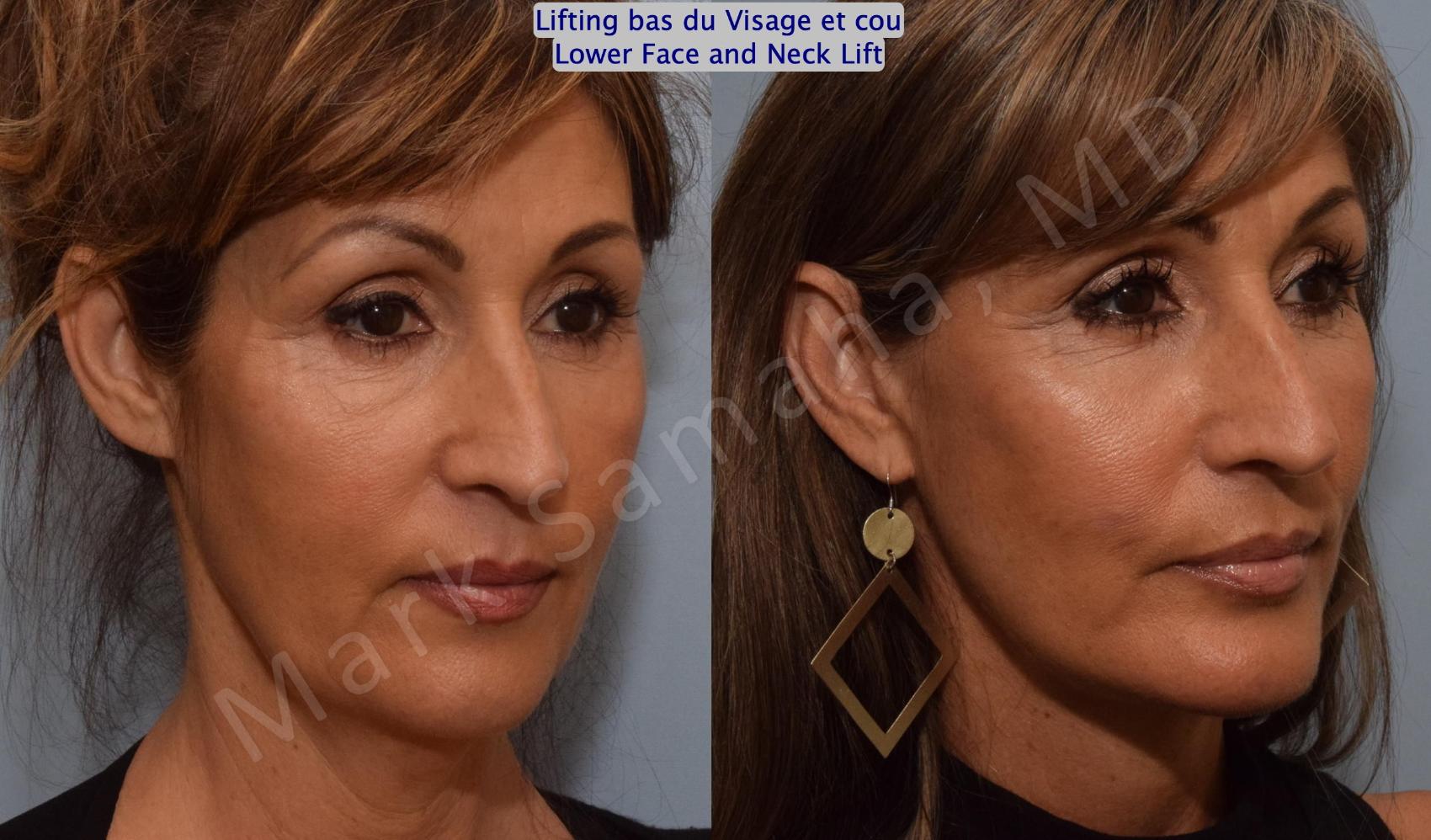 Before & After Lifting du visage / Cou - Facelift / Necklift Case 159 Right Oblique View in Montreal, QC