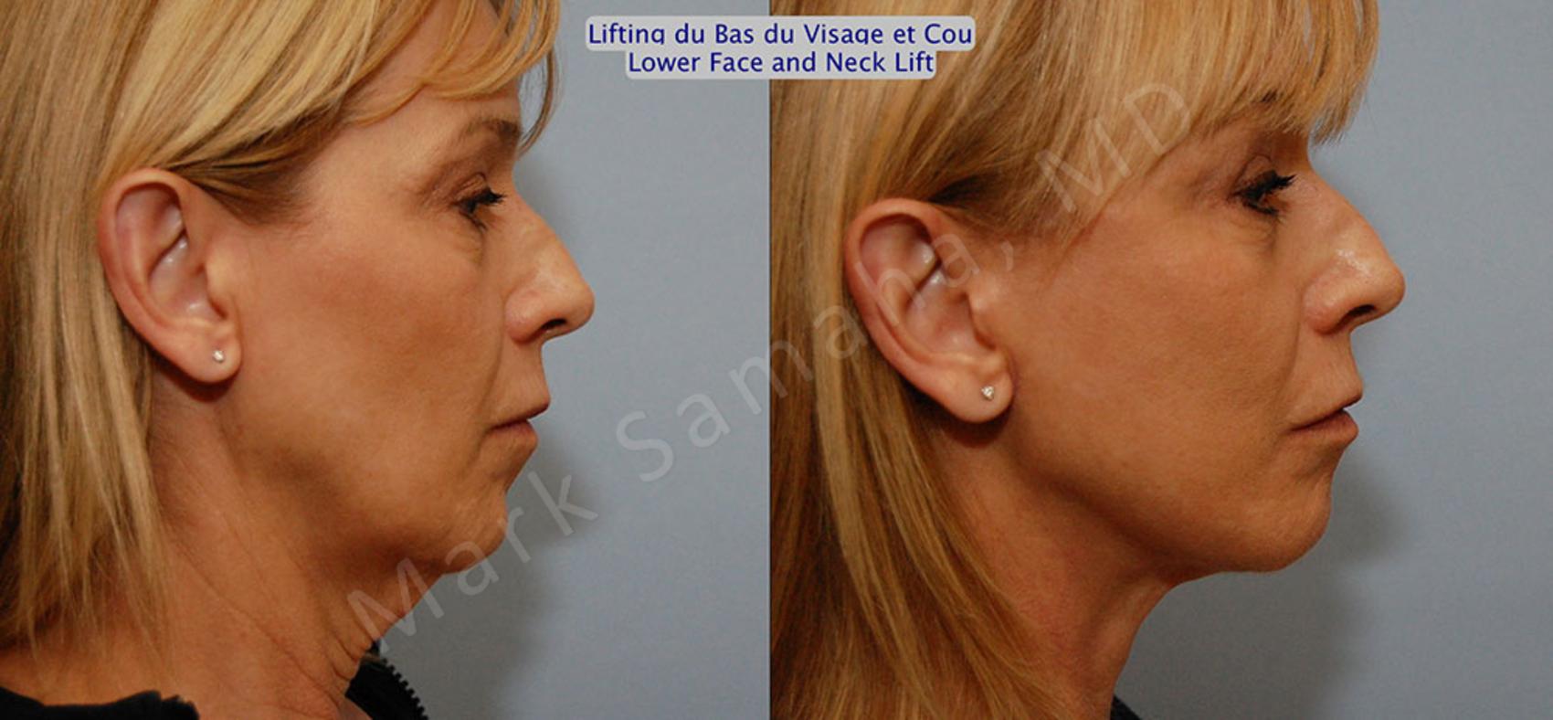 Before & After Lifting du visage / Cou - Facelift / Necklift Case 16 View #6 View in Montreal, QC