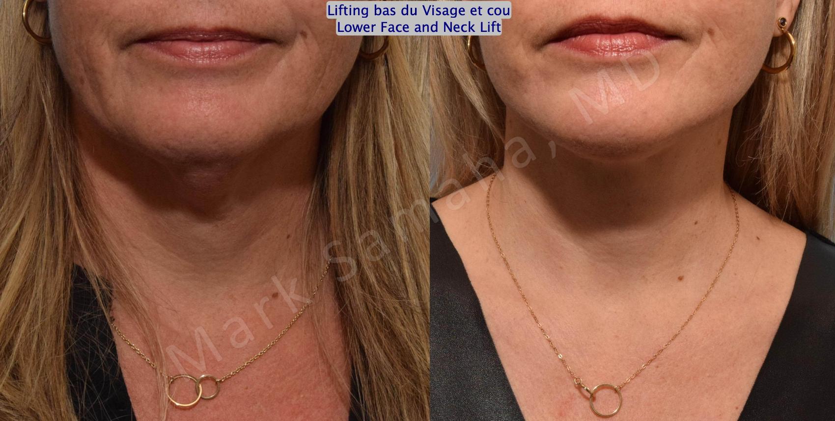 Before & After Lifting du visage / Cou - Facelift / Necklift Case 160 Frontal Neck Cou View in Montreal, QC