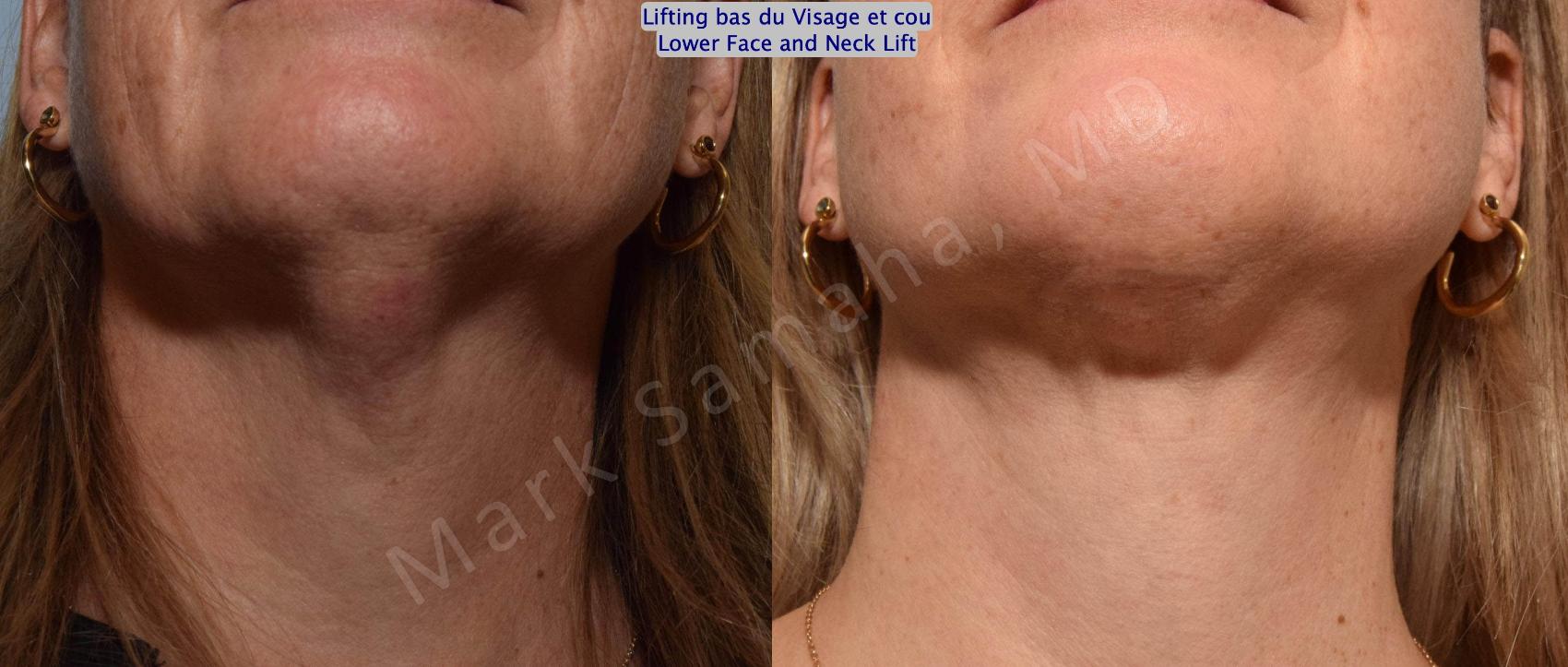 Before & After Lifting du visage / Cou - Facelift / Necklift Case 160 Neck Cou View in Montreal, QC