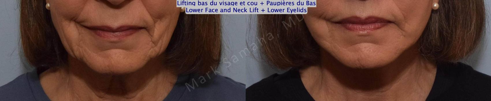 Before & After Lifting du visage / Cou - Facelift / Necklift Case 162 Front View in Montreal, QC