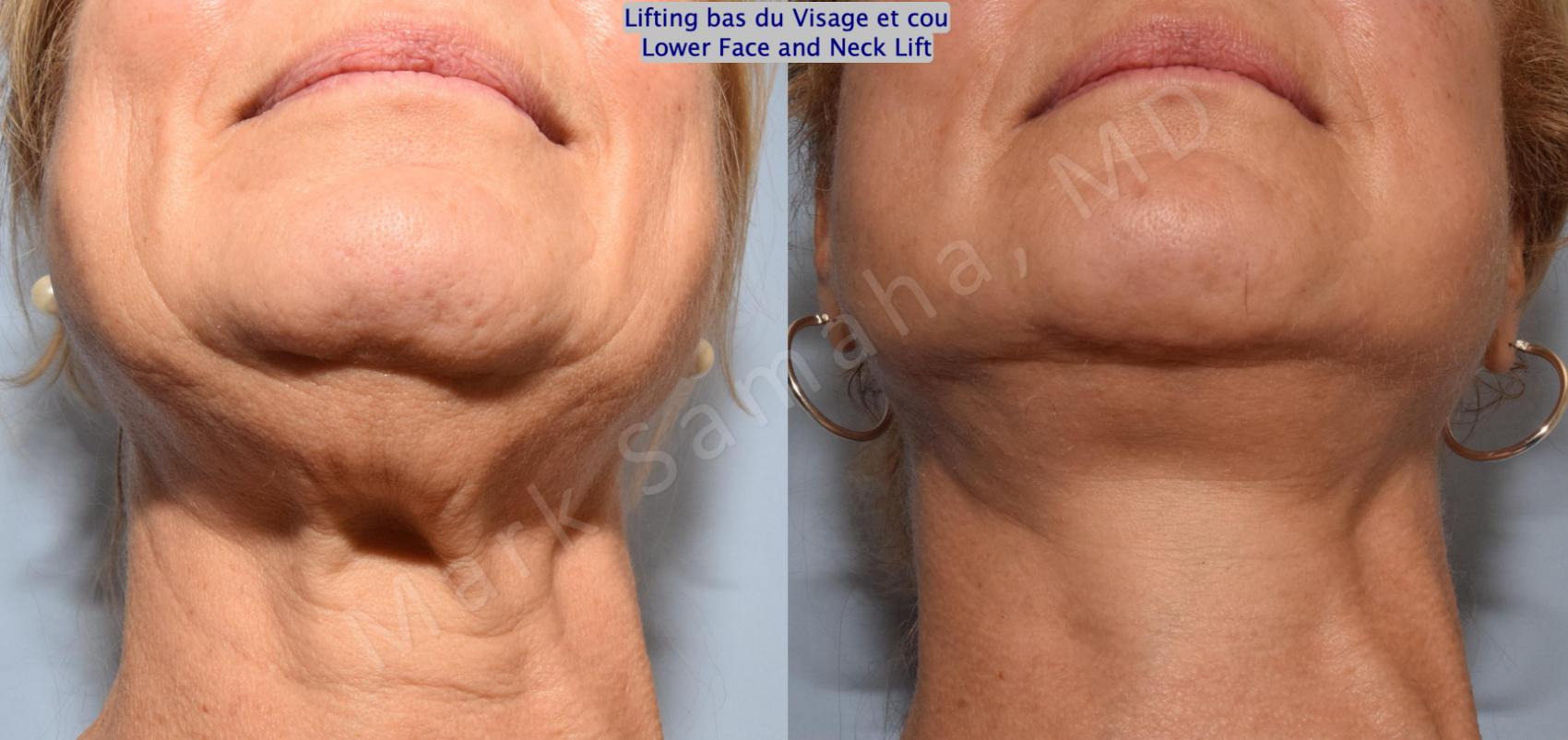 Before & After Lifting du visage / Cou - Facelift / Necklift Case 164 Neck Cou View in Montreal, QC