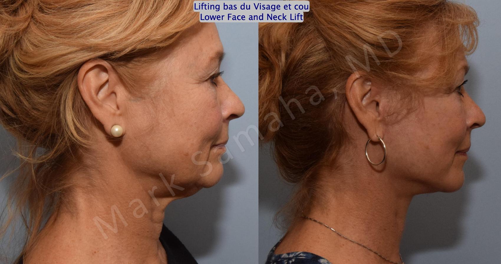 Before & After Lifting du visage / Cou - Facelift / Necklift Case 164 Right Side View in Montreal, QC