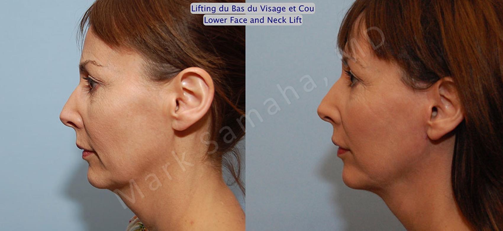 Before & After Lifting du visage / Cou - Facelift / Necklift Case 18 View #2 View in Montreal, QC